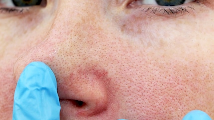Le vene visibili sono un precursore del naso bulboso che si sviluppa nella fase successiva in caso di rosacea non trattata.