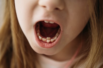 Non è un fenomeno raro: il dente permanente è già spuntato prima che il dente da latte sia caduto.