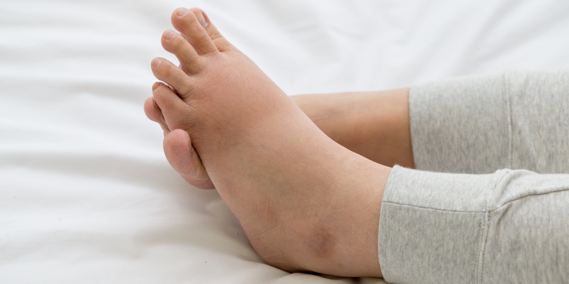 Gambe gonfie? Consigli e rimedi