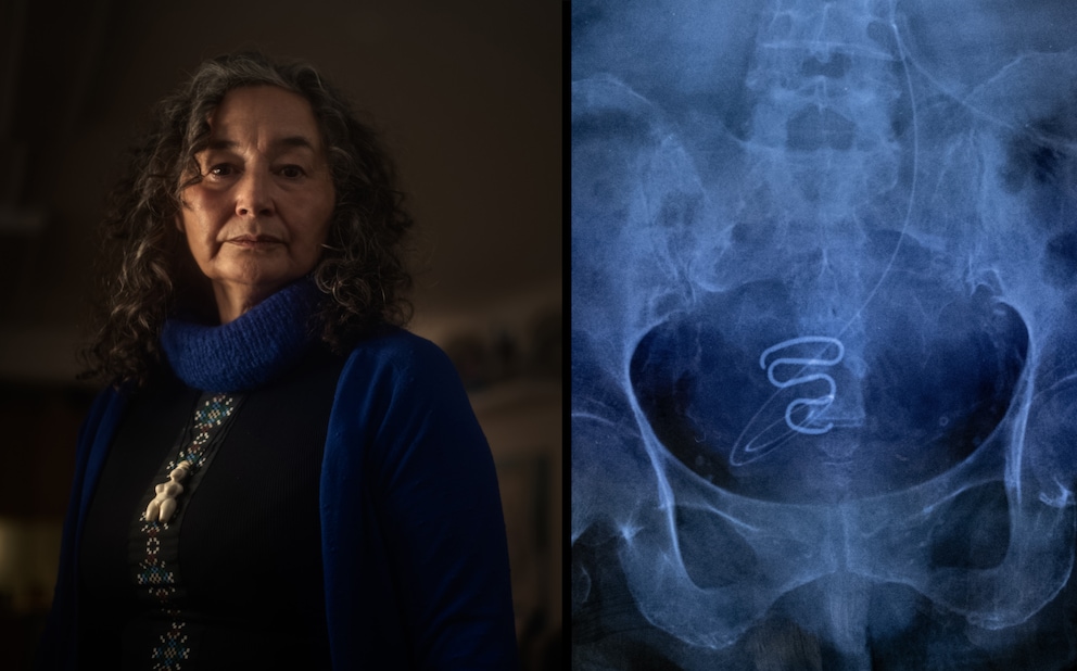 In 2019, Nanja Lyberth (left) told her story of suffering to a local newspaper in Nuuk - and got the scandal rolling. On the right, a photographed X-ray image of an implanted IUD.