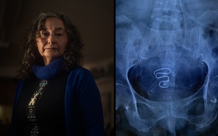 Nel 2019, Nanja Lyberth (a sinistra) raccontò la sua storia di sofferenza a un giornale locale di Nuuk - e fece scoppiare lo scandalo. A destra, un'immagine radiografica di uno IUD impiantato.