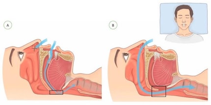 Il percorso e il volume dell'aria quando si confronta la respirazione con la bocca (A) con quella nasale (B).