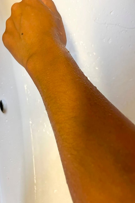... e i tatuaggi sono completamente rimossi.