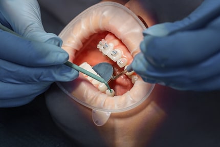 Gli apparecchi ortodontici possono essere molto costosi; disporre di una buona assicurazione è un valido aiuto.