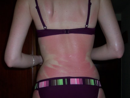 The downside of summer. I was young and stupid.
